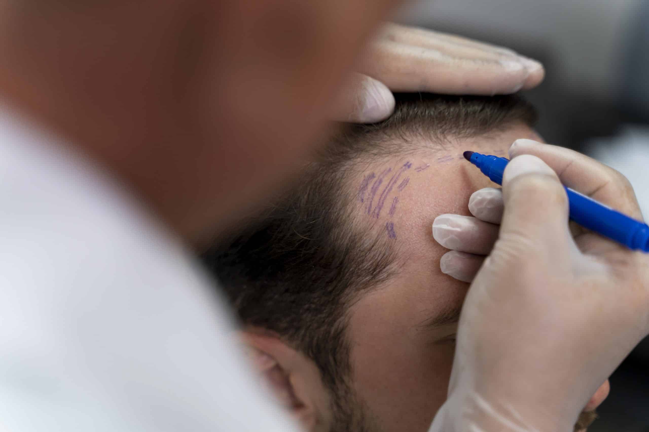 A person wearing gloves uses a blue marker to draw lines on another person's hairline, likely preparing for a medical or cosmetic procedure.