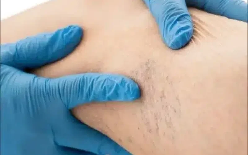 A person wearing blue medical gloves examines a patient's skin for varicose veins or other vascular issues.