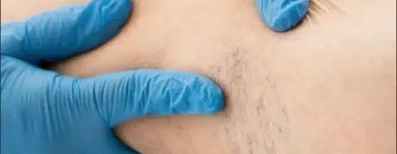 A person wearing blue medical gloves examines a patient's skin for varicose veins or other vascular issues.
